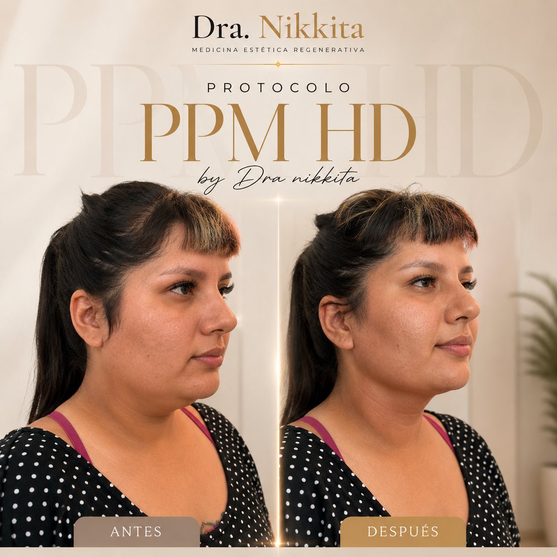 Resultado de lipopapada: papada reducida y mentón definido, caso 2 — Dra. Nikkita