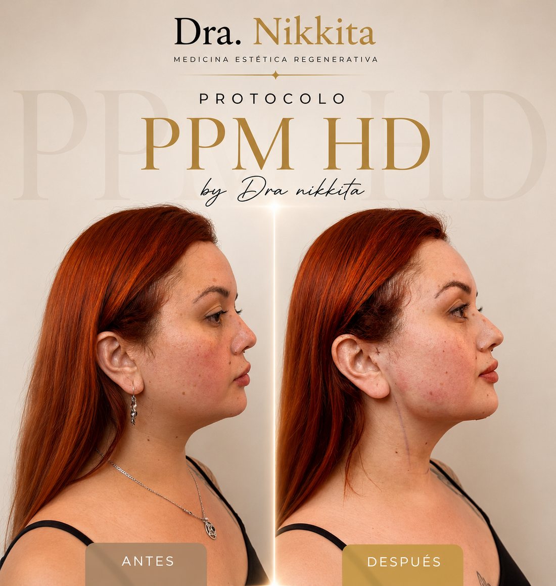 Contorno facial definido tras lipopapada, antes y después caso 4 — Dra. Nikkita