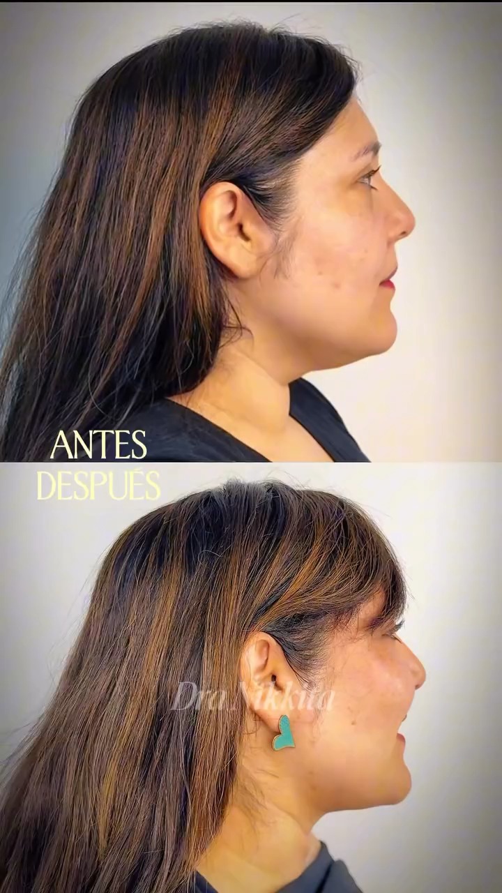 Fotograma del reel publicado por @dranikkita: Melisa de perfil, arriba rotulada «antes» y abajo «después» de la Lipopapada HD, con el ángulo entre el mentón y el cuello más definido.
