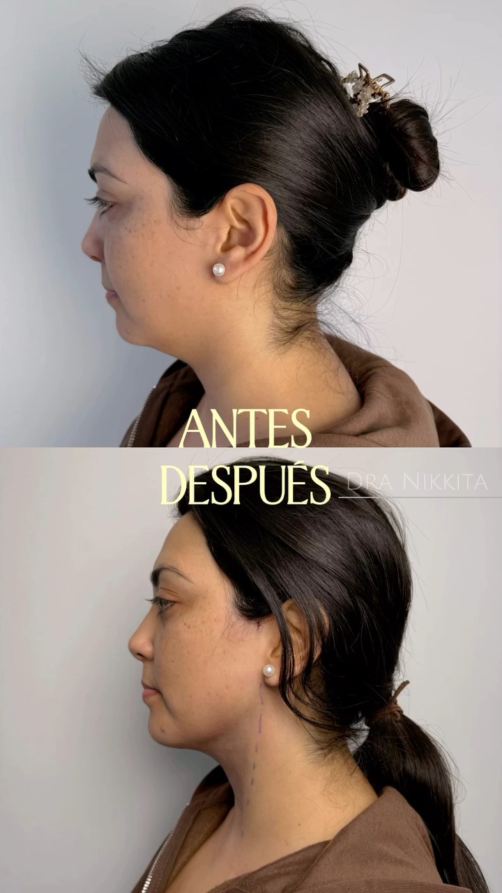 Fotograma del reel publicado por @dranikkita: Noemí de perfil, arriba rotulada «antes» y abajo «después» de la Lipopapada HD, con el borde de la mandíbula y el cuello más definidos.
