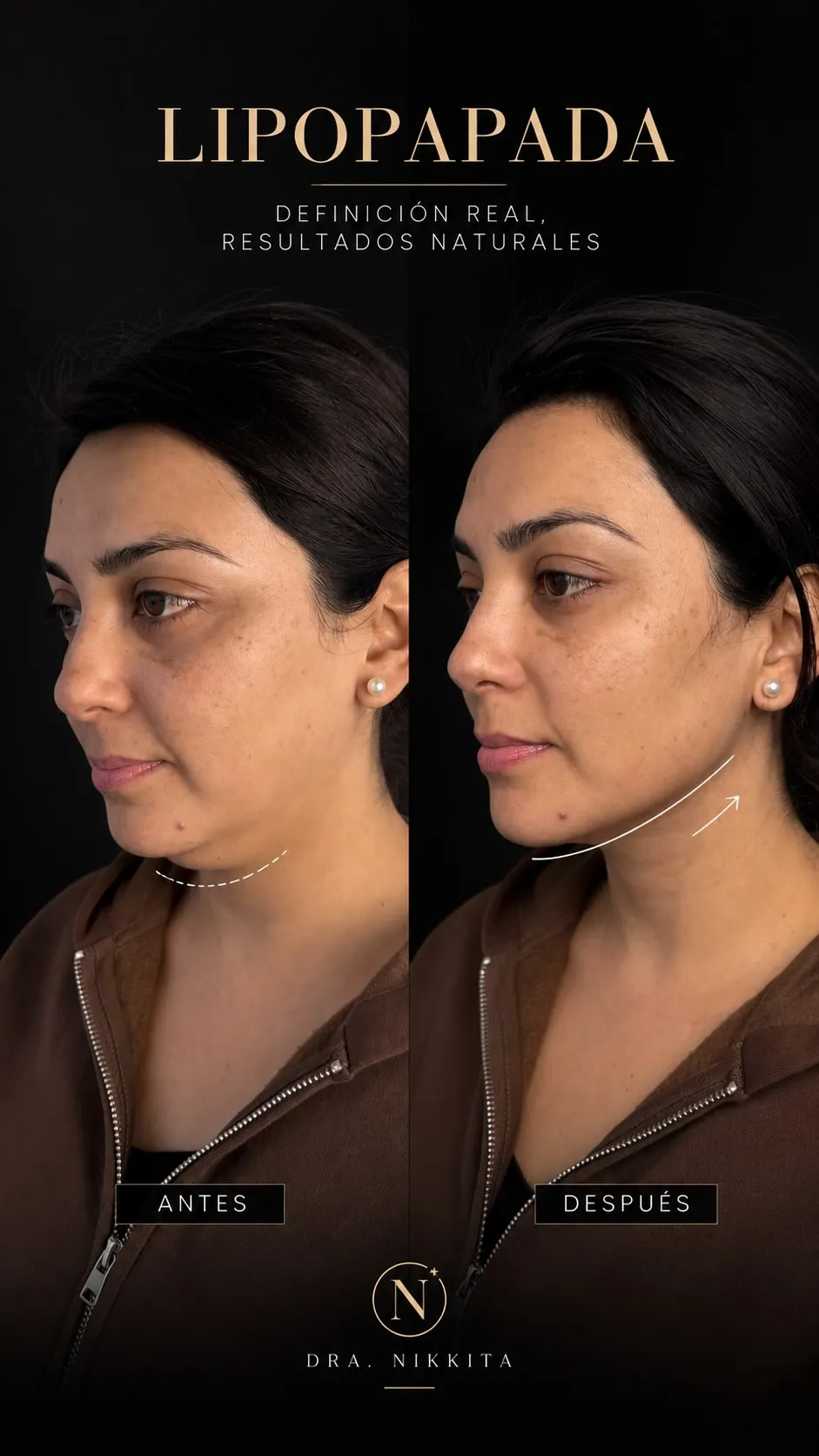 Tarjeta del caso de Noemí: su perfil de antes y de después de la Lipopapada HD, marcados «antes» y «después».